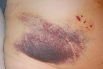 Understanding the Different Techniques for Gallbladder Removal