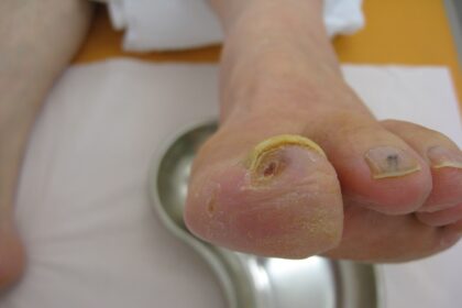 What Is Vascular Disease?