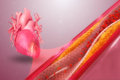 What You Need to Know About Coronary Artery Disease