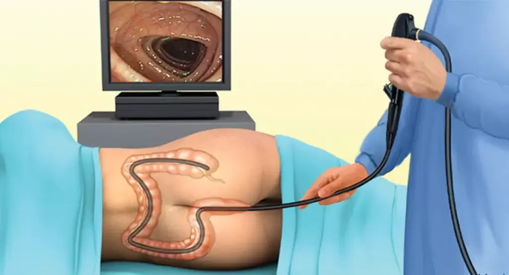 What to Expect During a Colonoscopy