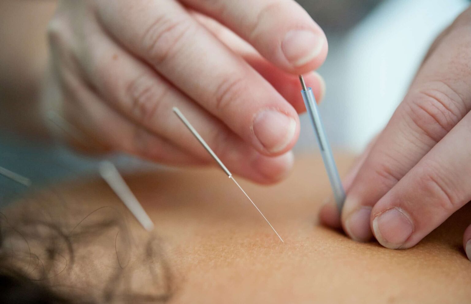 What to Look For When Choosing the Right Acupuncturist