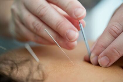 What to Look For When Choosing the Right Acupuncturist