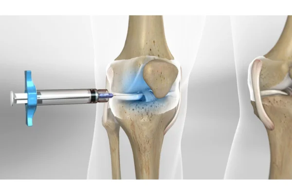 How Robotic Joint Replacement is Transforming Joint Surgery