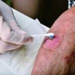 Knowing When to See a Doctor for Wound Care