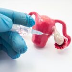 What Is Ovulation Induction and When Is It Needed?