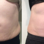 QuantumRF Treatments for Tightening Loose Skin