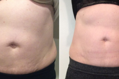 QuantumRF Treatments for Tightening Loose Skin