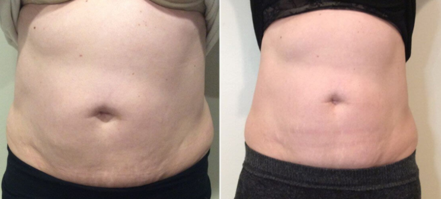 QuantumRF Treatments for Tightening Loose Skin