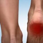 Causes and Treatments for Heel Pain