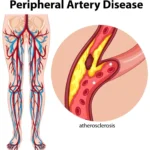 The Role of a Vascular Surgeon in Treating Peripheral Artery Disease