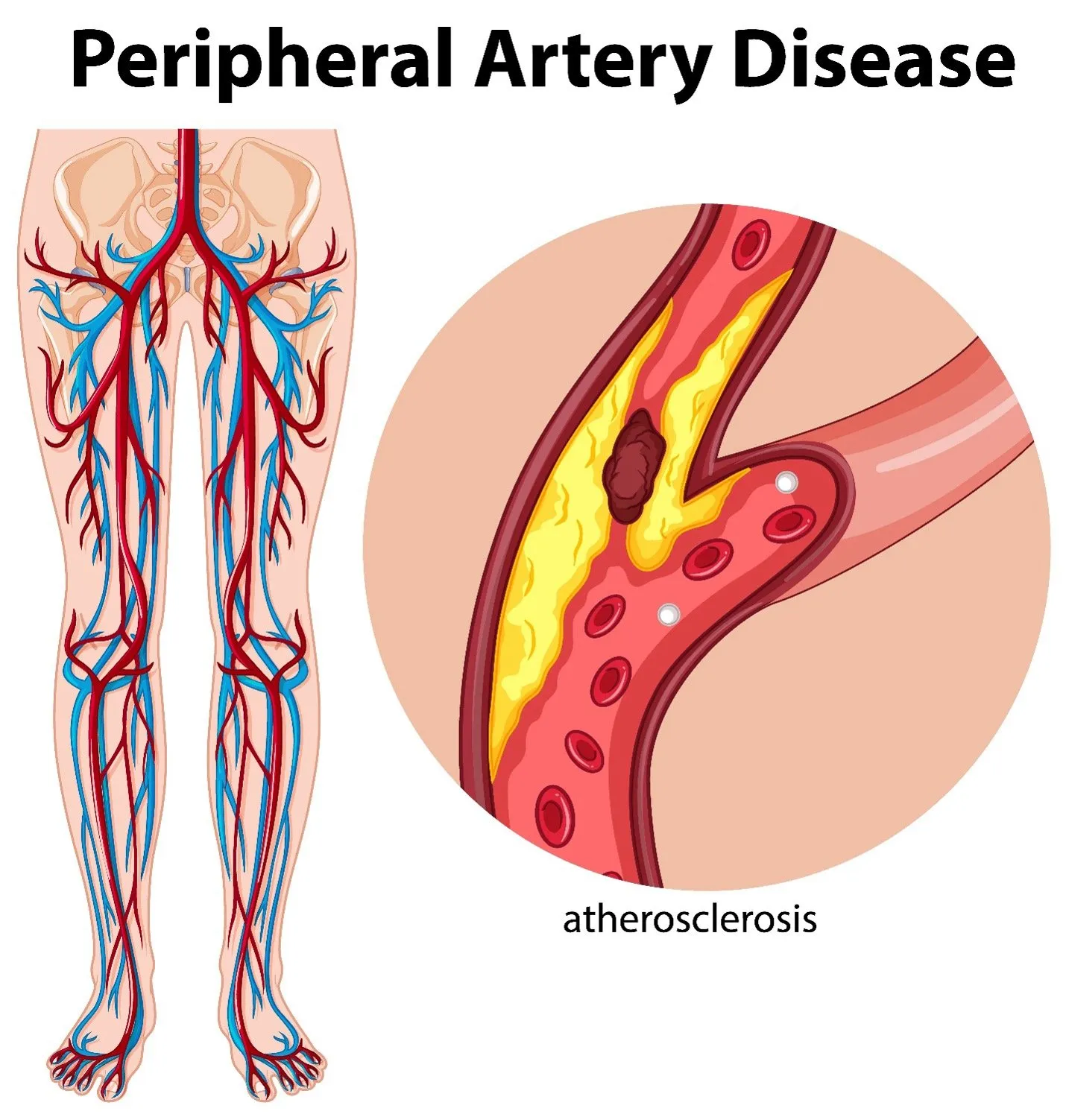 The Role of a Vascular Surgeon in Treating Peripheral Artery Disease