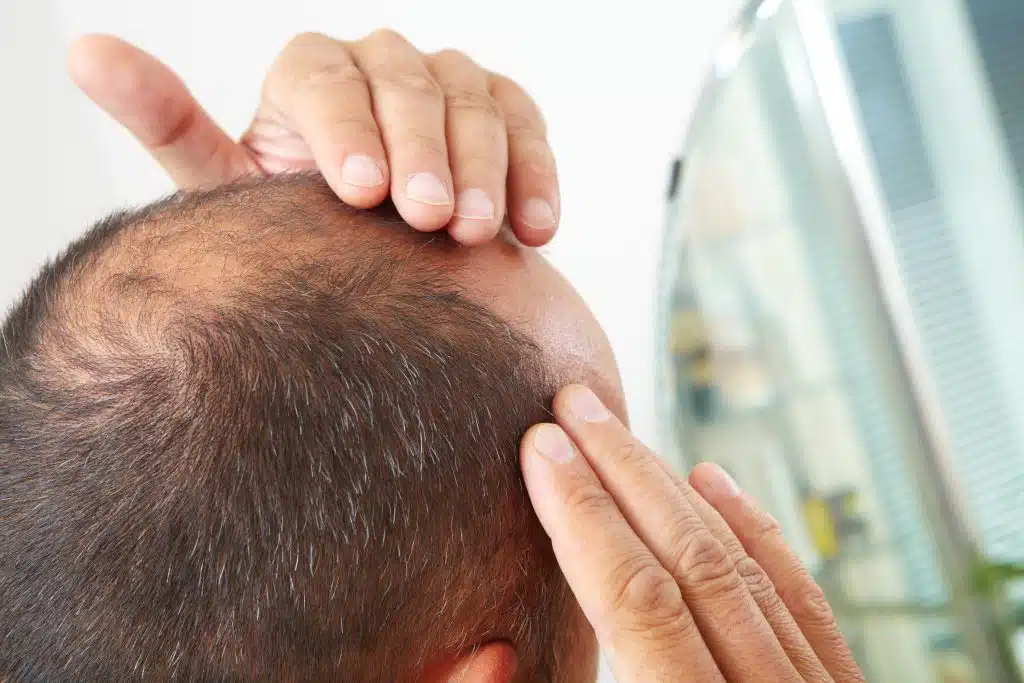 Understanding the Different Types of Hair Loss